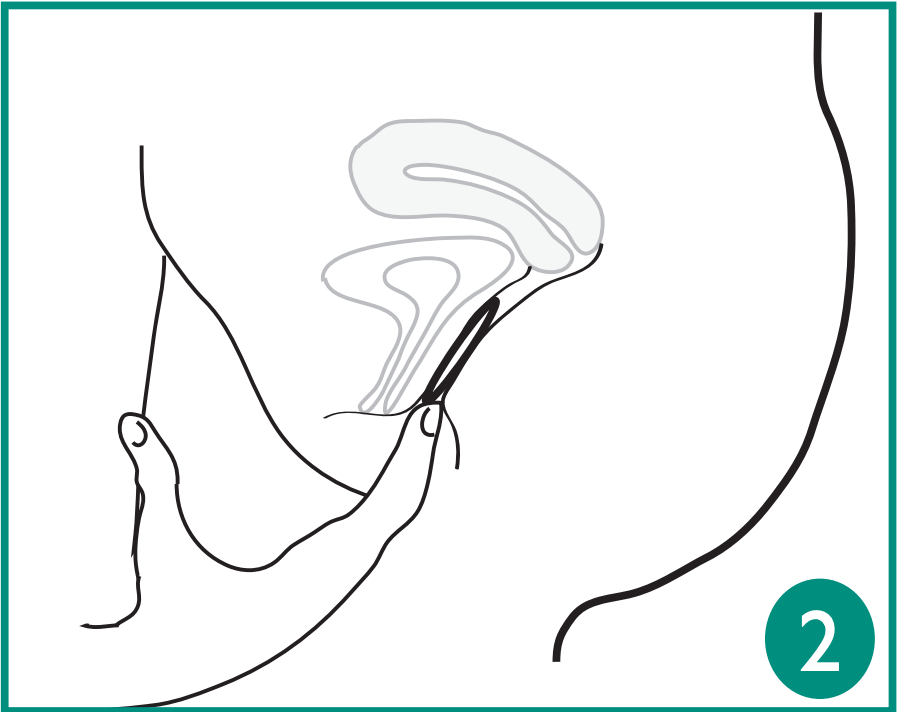 Step 2 of inserting the Progesterone-Releasing Vaginal Ring