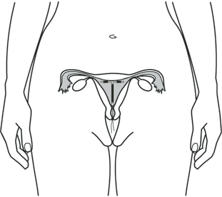 Placement of an IUD in Utero