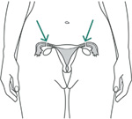 Female anatomy with arrows pointing to cuts for female sterilization