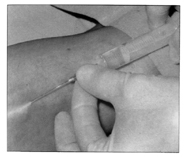 A woman receiving an injection under the skin to prevent pain while implants are being inserted