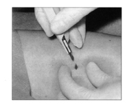The provider makes a small incision in the skin on the inside of the upper arm