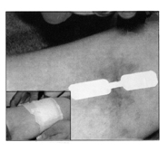 The provider closes the incision with an adhesive bandage
