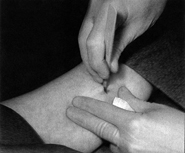 The health care provider makes a small incision in the skin on the inside of the upper arm, near the site of insertion